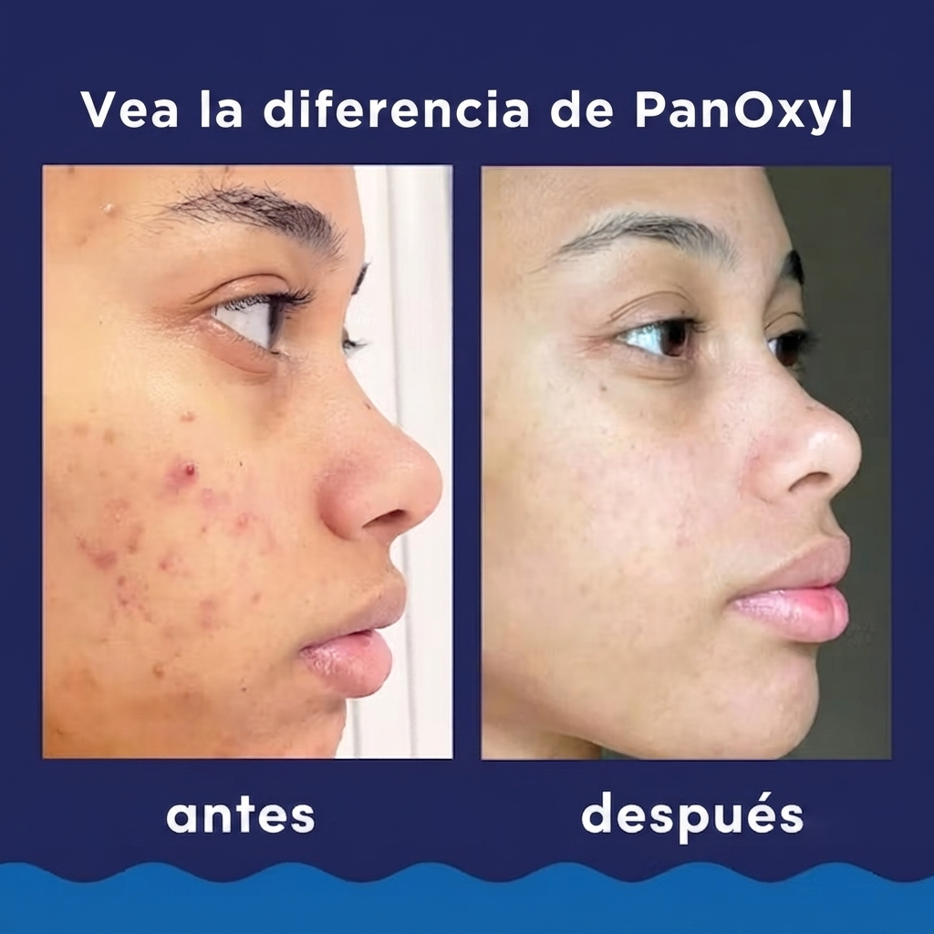 PanOxyl 4% Benzoyl Peroxide Acne Creamy Wash, limpiador facial y corporal para el acné 170 g