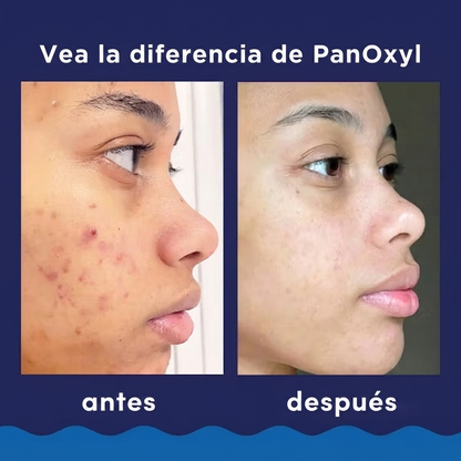 PanOxyl 4% Benzoyl Peroxide Acne Creamy Wash, limpiador facial y corporal para el acné 170 g